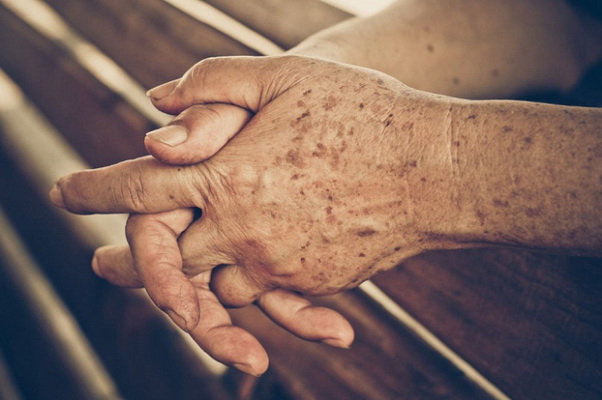D�y sừng da xuất hiện ở người ngo�i 50 tuổi.
