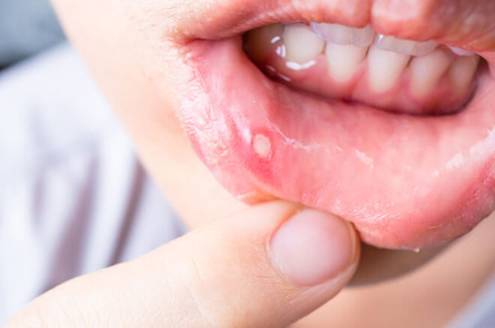 Biểu hiện của nhiệt miệng